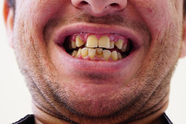Sådan vælger du mellem Invisalign og klassisk bøjle i hverdagen